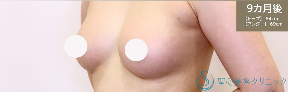 【30代女性・しっかりとしたバストアップ】プレミアムピュアグラフト豊胸術（2回後）（術後3ヶ月） After 