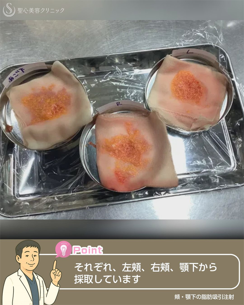 【20代女性・フェイスラインスッキリ】脂肪吸引注射（頬・顎下）（半年後） After 