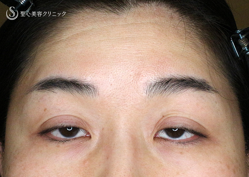 【49歳女性・重度のコンタクトレンズ眼瞼下垂】切らない眼瞼下垂+α法（術直後〜3ヶ月後） Before 