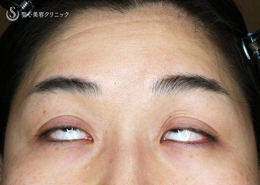 【49歳女性・重度のコンタクトレンズ眼瞼下垂】切らない眼瞼下垂+α法（術直後〜3ヶ月後） Before 