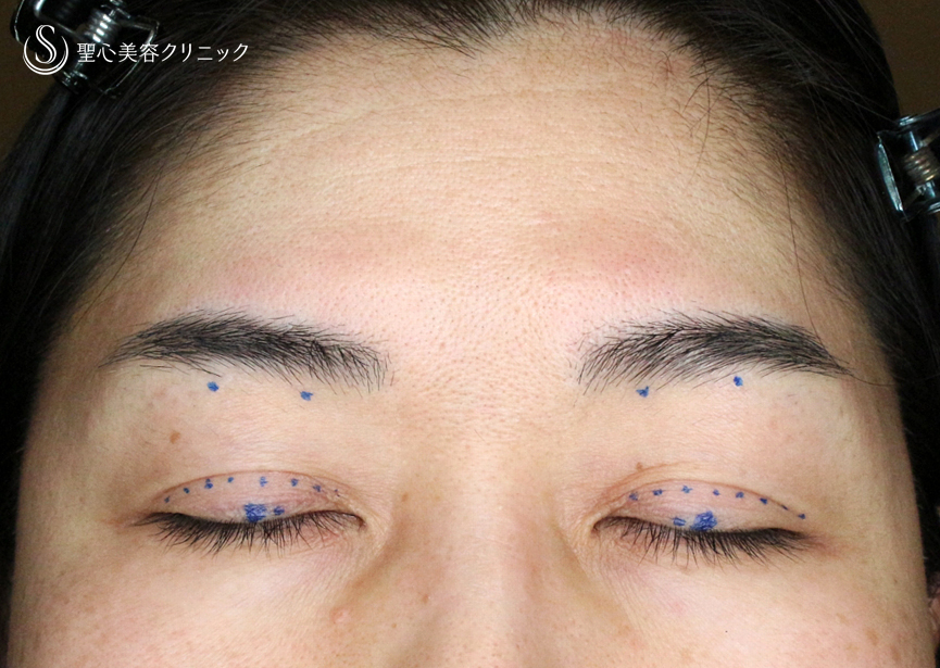 【49歳女性・重度のコンタクトレンズ眼瞼下垂】切らない眼瞼下垂+α法（術直後〜3ヶ月後） Before 