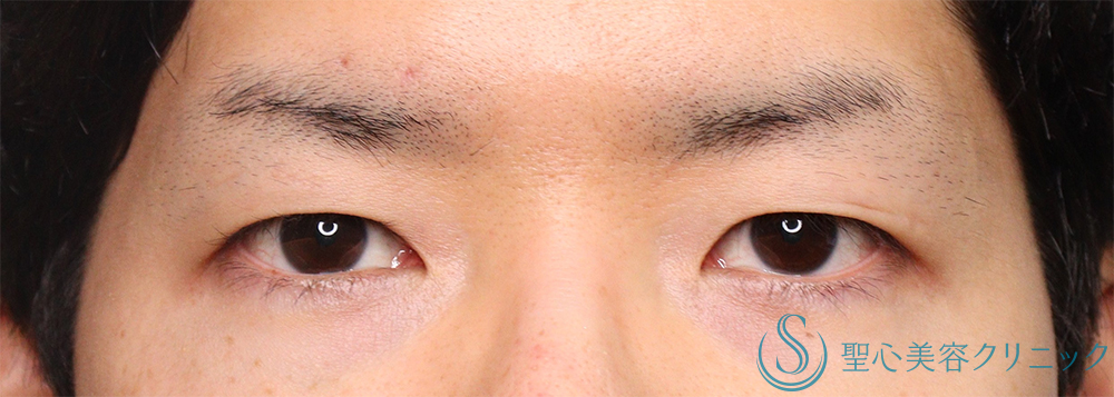 【30代男性・明るい印象かつ楽な開瞼】二重術（切開法）部分切開/全切開（術後1ヶ月） Before 