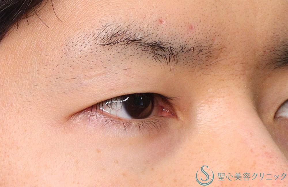 【30代男性・明るい印象かつ楽な開瞼】二重術（切開法）部分切開/全切開（術後1ヶ月） Before 