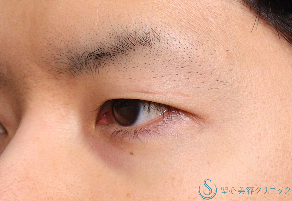 【30代男性・明るい印象かつ楽な開瞼】二重術（切開法）部分切開/全切開（術後1ヶ月） Before 