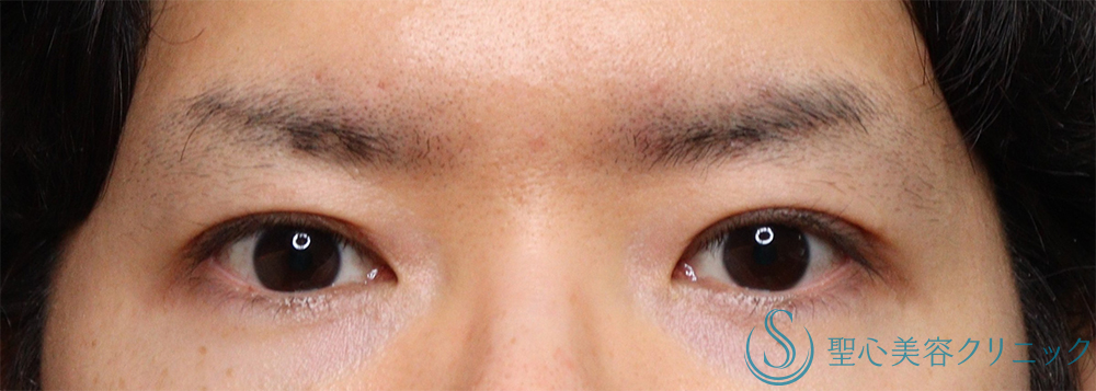 【30代男性・明るい印象かつ楽な開瞼】二重術（切開法）部分切開/全切開（術後1ヶ月） After 