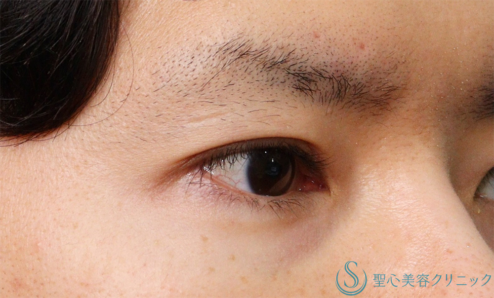 【30代男性・明るい印象かつ楽な開瞼】二重術（切開法）部分切開/全切開（術後1ヶ月） After 