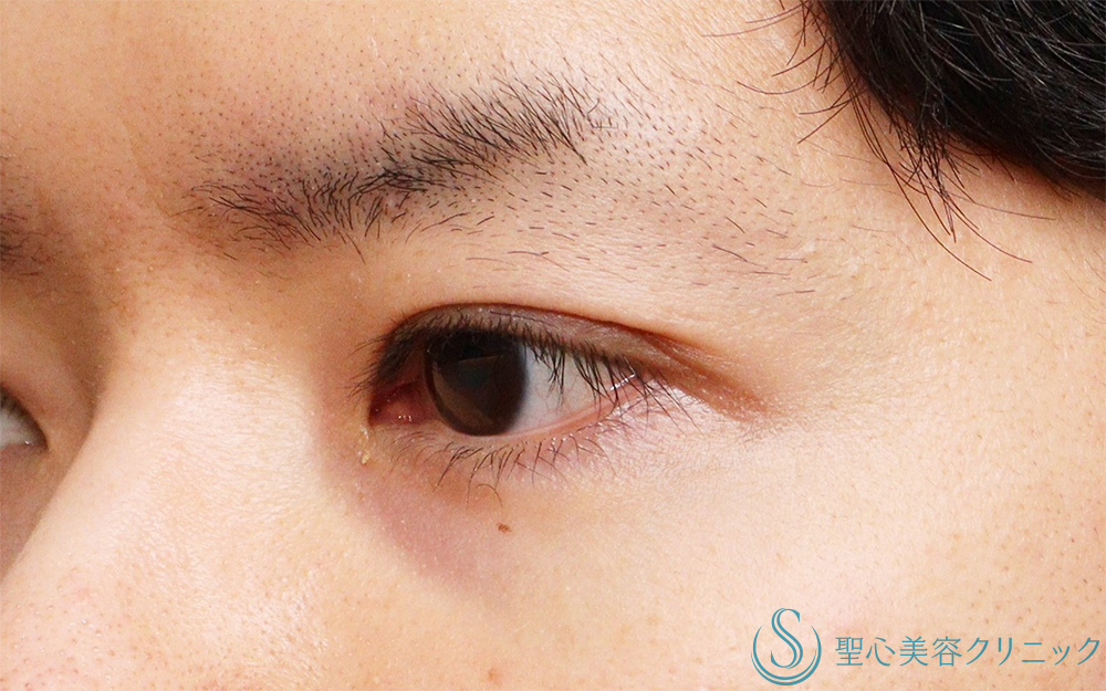 【30代男性・明るい印象かつ楽な開瞼】二重術（切開法）部分切開/全切開（術後1ヶ月） After 