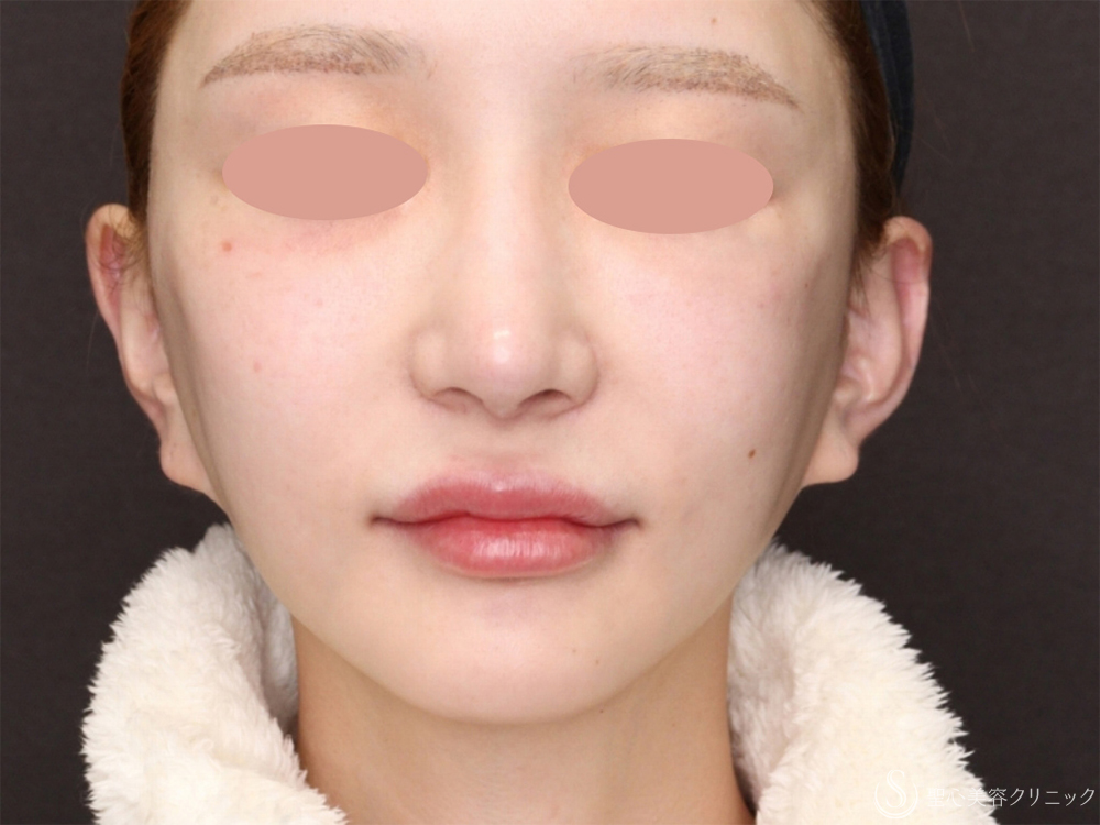 フィオラスレッド エスト FL_Before