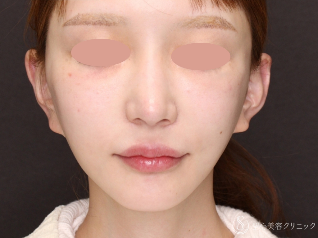 フィオラスレッド エスト FL_After