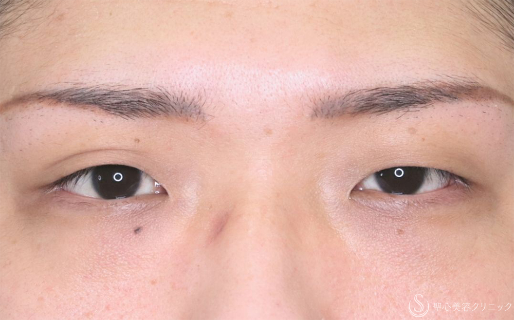 【30代男性・スッキリした印象の目】二重術（埋没法）：マイクロメソッド+α（3点）（直後） Before 