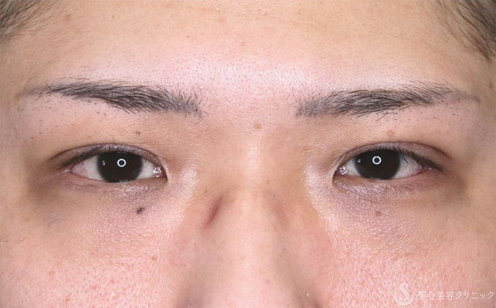 【30代男性・スッキリした印象の目】二重術（埋没法）：マイクロメソッド+α（3点）（直後） After 