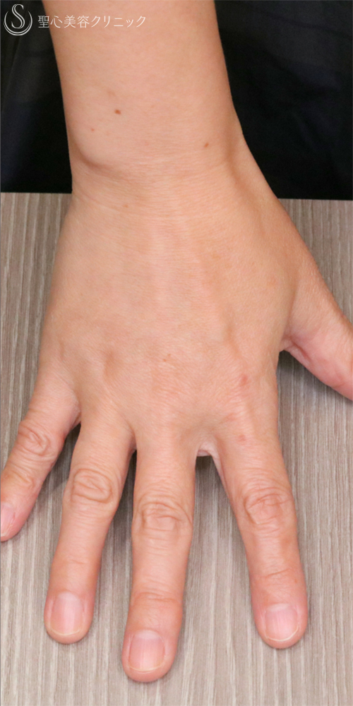 【50代女性・手の甲を注射でふっくら】プレミアムPRP皮膚再生療法（手の甲）（6ヶ月後） After 