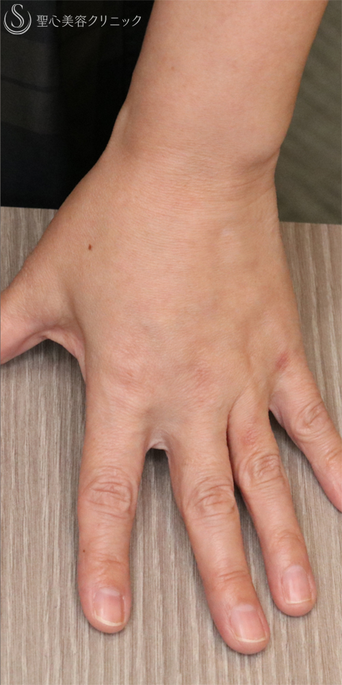 【50代女性・手の甲を注射でふっくら】プレミアムPRP皮膚再生療法（手の甲）（6ヶ月後） After 