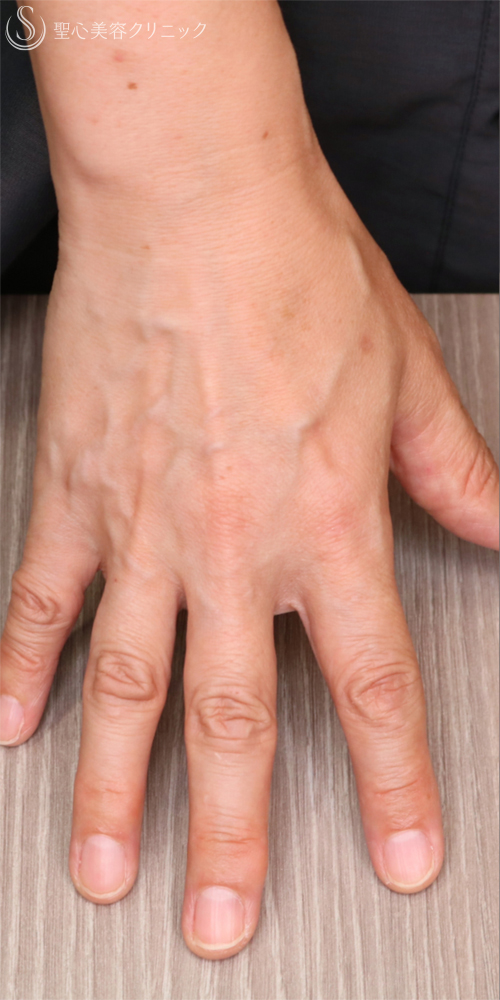 【50代女性・手の甲を注射でふっくら】プレミアムPRP皮膚再生療法（手の甲）（6ヶ月後） Before 