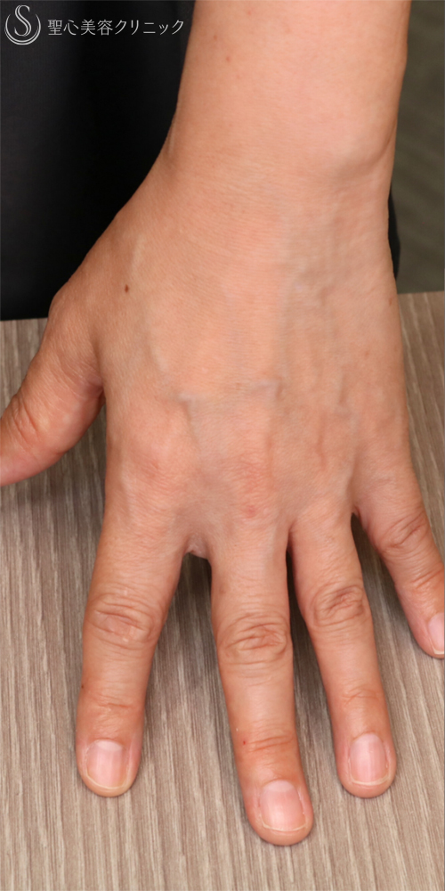 【50代女性・手の甲を注射でふっくら】プレミアムPRP皮膚再生療法（手の甲）（6ヶ月後） Before 