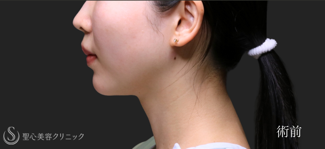 【30代女性・脂肪吸引で顎下にくびれを】ベイザーリポ2.2脂肪吸引（術後6ヶ月） Before 