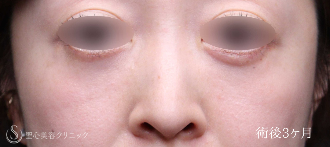 【40代女性・目のクマをスッキリ解消】下眼瞼切開術/下眼瞼除皺術/ハムラ法（術後1週間～3ヶ月） After 