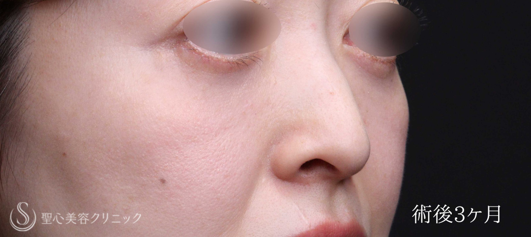 【40代女性・目のクマをスッキリ解消】下眼瞼切開術/下眼瞼除皺術/ハムラ法（術後1週間～3ヶ月） After 