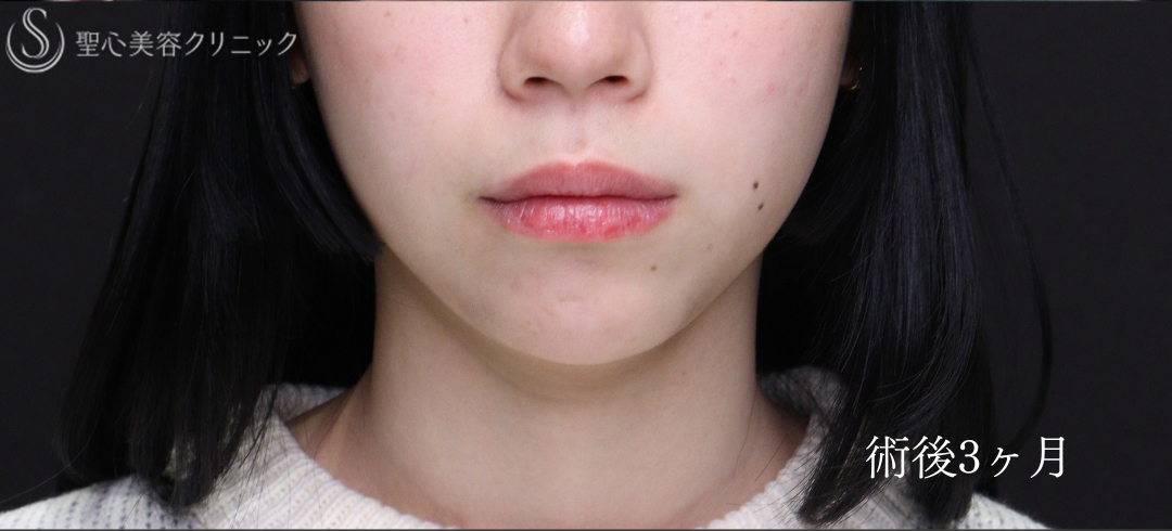 【20代女性・Eラインを整えることで輪郭を激変】あごプロテーゼ（術後1ヶ月～3ヶ月） After 