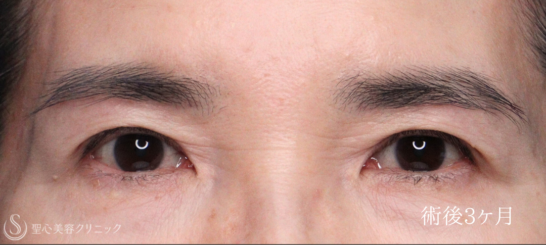 【60代女性・お目元のアンチエイジング施術でスッキリ瞼（まぶた）に】 眉下切開法（眉下リフト）＋ 目上切開（術後1ヶ月～3ヶ月） After 