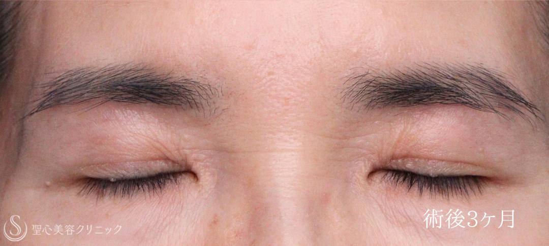 【60代女性・お目元のアンチエイジング施術でスッキリ瞼（まぶた）に】 眉下切開法（眉下リフト）＋ 目上切開（術後1ヶ月～3ヶ月） After 