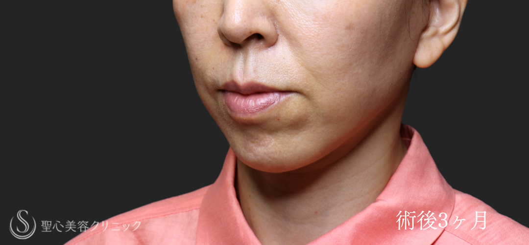 【50代女性・フェイスリフトで圧倒的な引き上げを】フェイスリフト（術後1ヶ月～3ヶ月後） After 