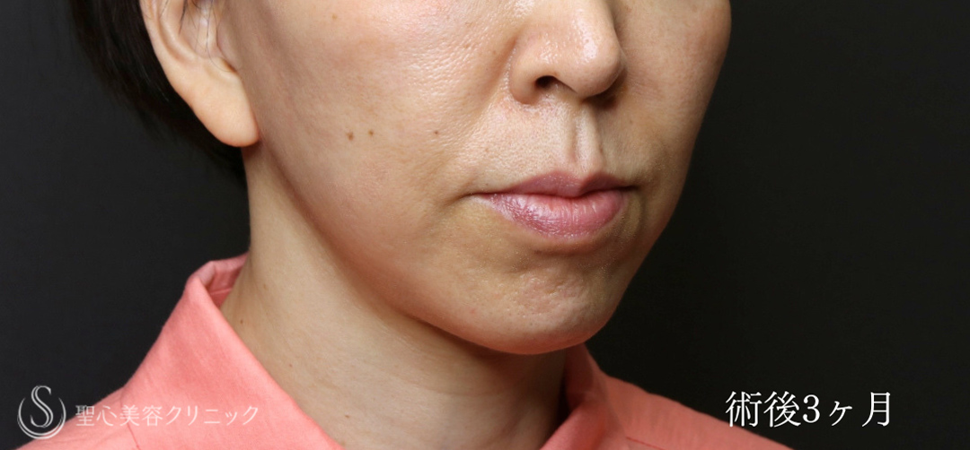【50代女性・フェイスリフトで圧倒的な引き上げを】フェイスリフト（術後1ヶ月～3ヶ月後） After 