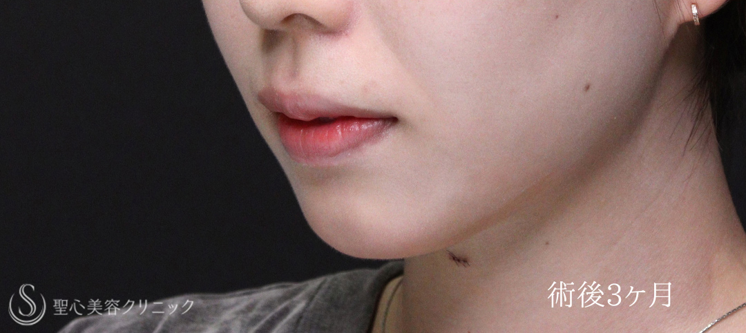 【20代女性・唇を薄くして上品な印象に】口唇縮小術（術後1週間～3ヶ月） After 