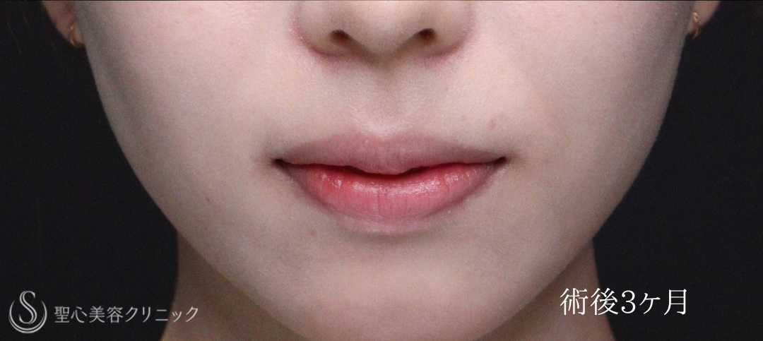 【20代女性・唇を薄くして上品な印象に】口唇縮小術（術後1週間～3ヶ月） After 
