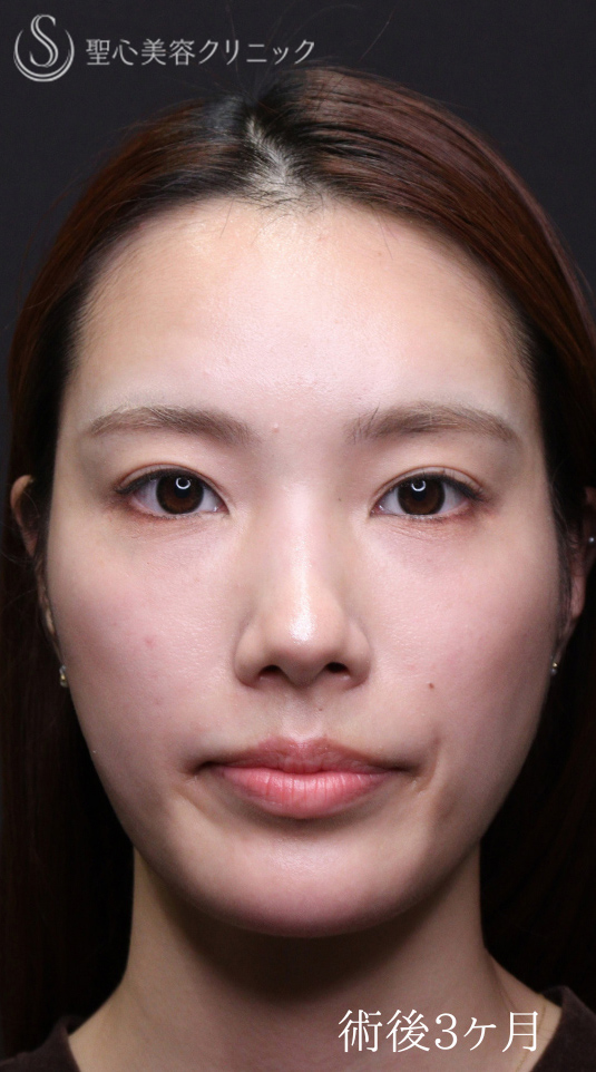 【20代女性・裏ハムラでクマを一掃】下眼瞼切開術/下眼瞼除皺術/ハムラ法（術後1〜３ヶ月） After 