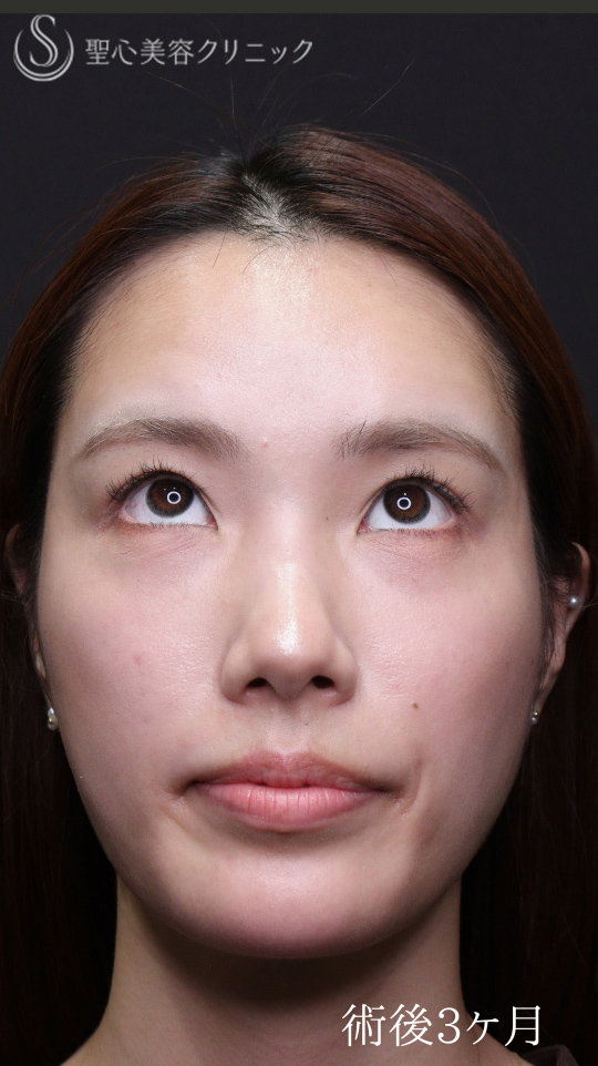 【20代女性・裏ハムラでクマを一掃】下眼瞼切開術/下眼瞼除皺術/ハムラ法（術後1〜３ヶ月） After 
