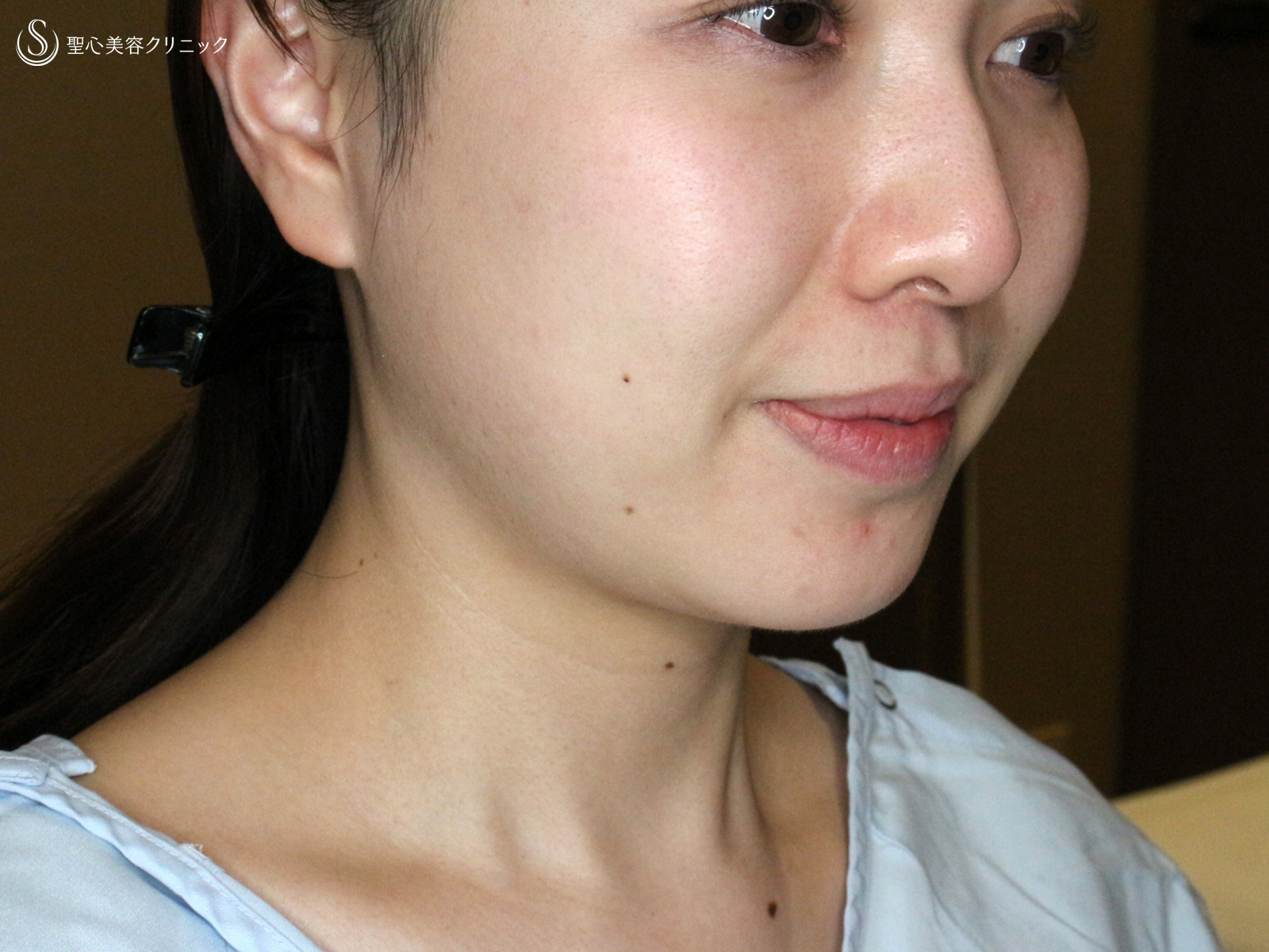 【20代女性・札幌院スタッフ】脂肪吸引注射「あご下」単独（術直後〜3ヶ月後） Before 