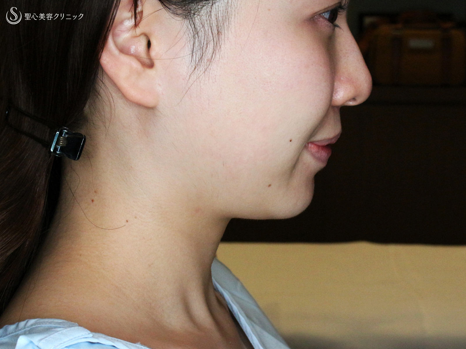【20代女性・札幌院スタッフ】脂肪吸引注射「あご下」単独（術直後〜3ヶ月後） Before 