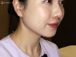 エラ張りの悩みを解決！専門家が教える原因と効果的な方法【エラ張り