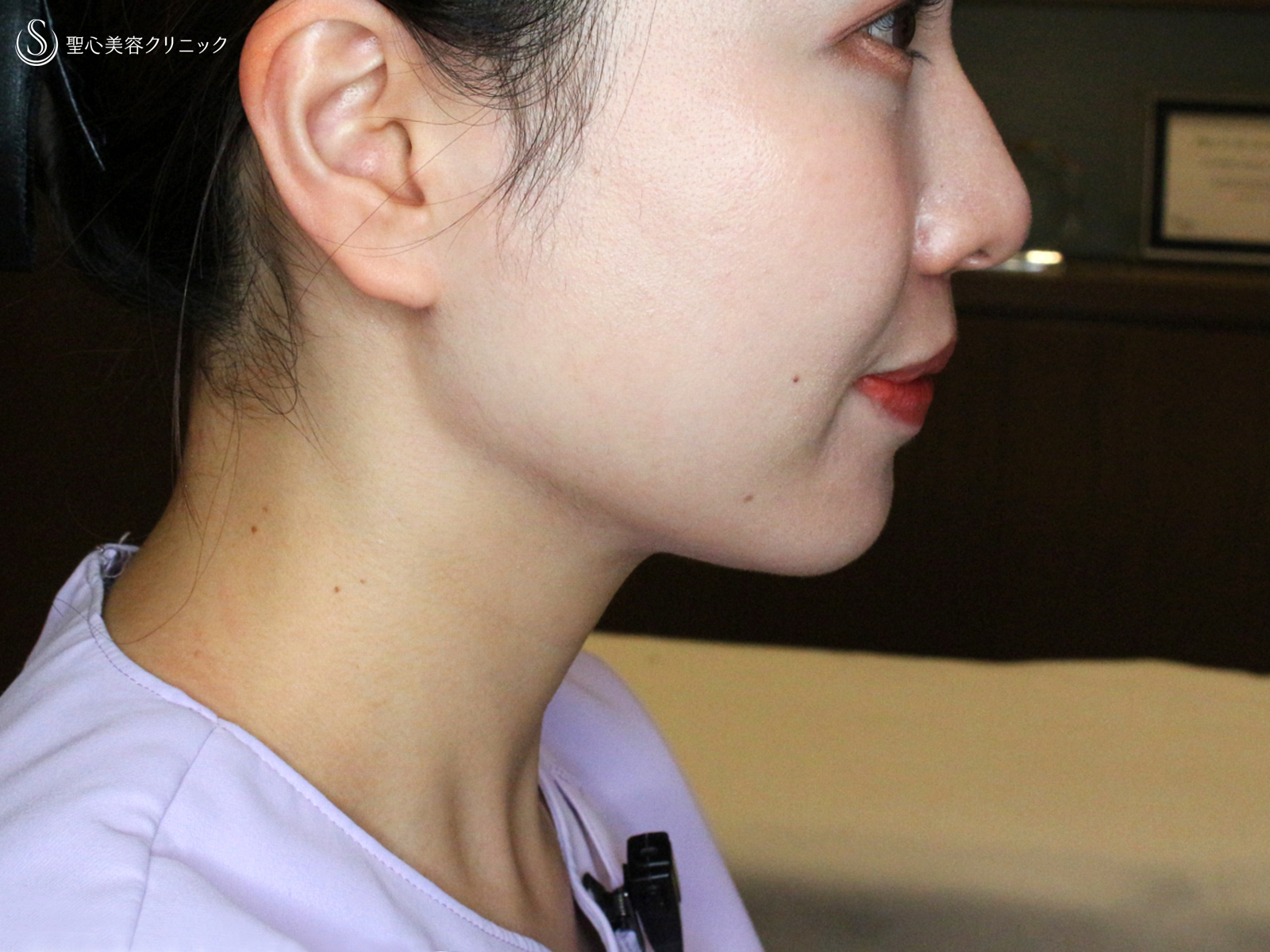 【20代女性・札幌院スタッフ】脂肪吸引注射「あご下」単独（術直後〜3ヶ月後） After 