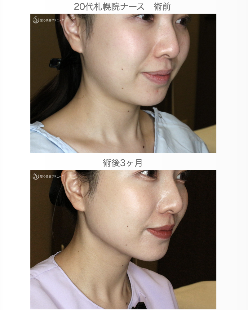 【20代女性・札幌院スタッフ】脂肪吸引注射「あご下」単独（術直後〜3ヶ月後） After 