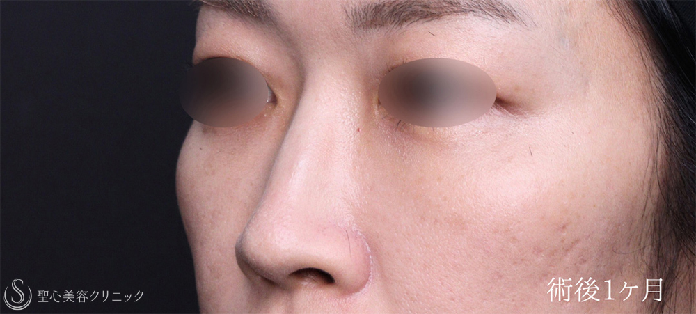 【30代女性・クマを無くしてスッキリ目元に】裏ハムラ法（1ヶ月後） After 