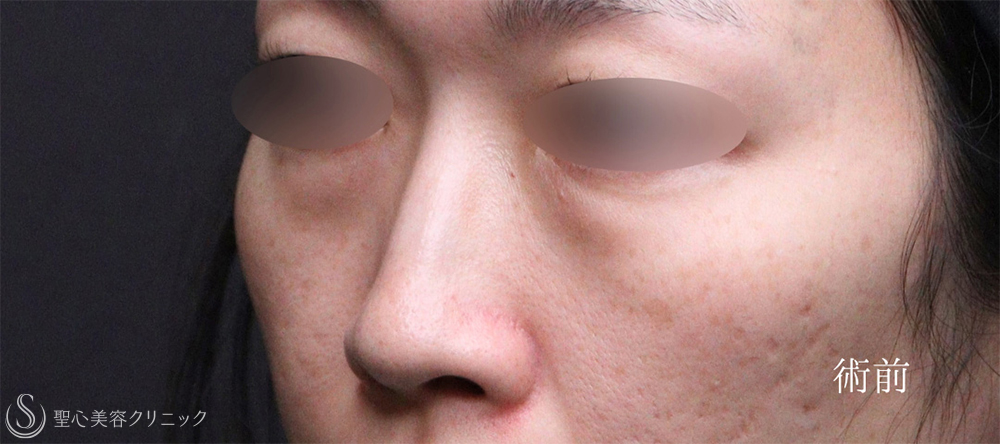 【30代女性・クマを無くしてスッキリ目元に】裏ハムラ法（1ヶ月後） Before 