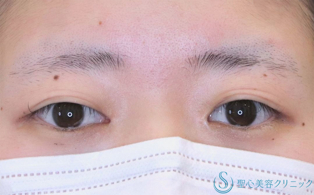 【20代女性・自然な二重に】 二重術（埋没法）：マイクロメソッド+α 3点（直後） Before 