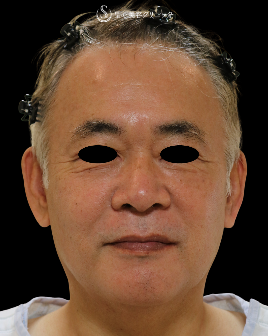 【60代男性・目の下の凹み】プレミアムPRP皮膚再生療法（5ヶ月後） After 