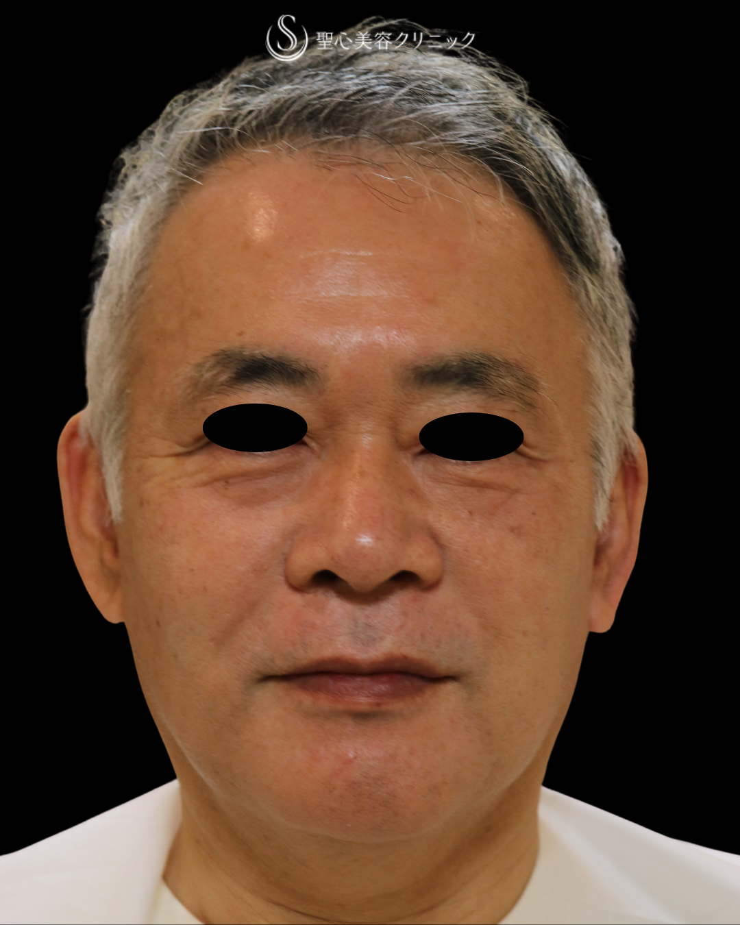 【60代男性・目の下の凹み】プレミアムPRP皮膚再生療法（5ヶ月後） Before 