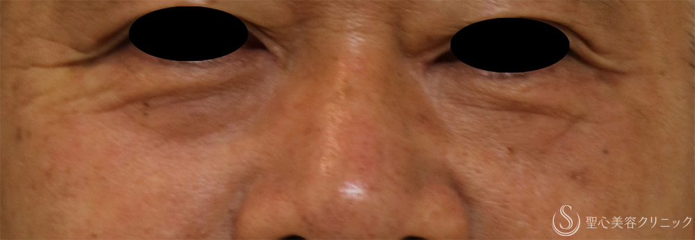 【60代男性・目の下の凹み】プレミアムPRP皮膚再生療法（5ヶ月後） Before 