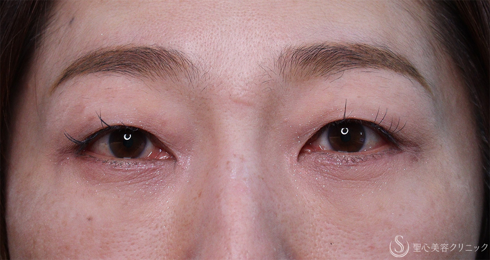 【50代女性・目の下のくま】ハムラ法（1週間後～1ヶ月後） After 
