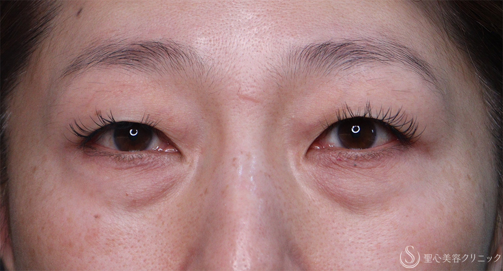 【50代女性・目の下のくま】ハムラ法（1週間後～1ヶ月後） Before 