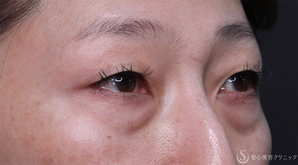【50代女性・目の下のくま】ハムラ法（1週間後～1ヶ月後） Before 