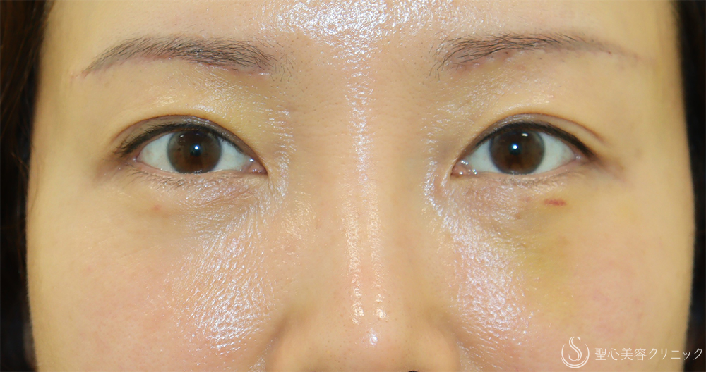 【40代女性・目の上のたるみ処置で若返り】眉下切開法（眉下リフト）（1週間後） After 
