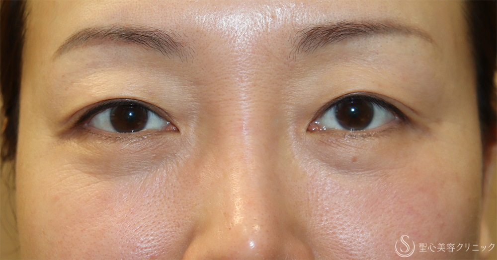 【40代女性・目の上のたるみ処置で若返り】眉下切開法（眉下リフト）（1週間後） Before 