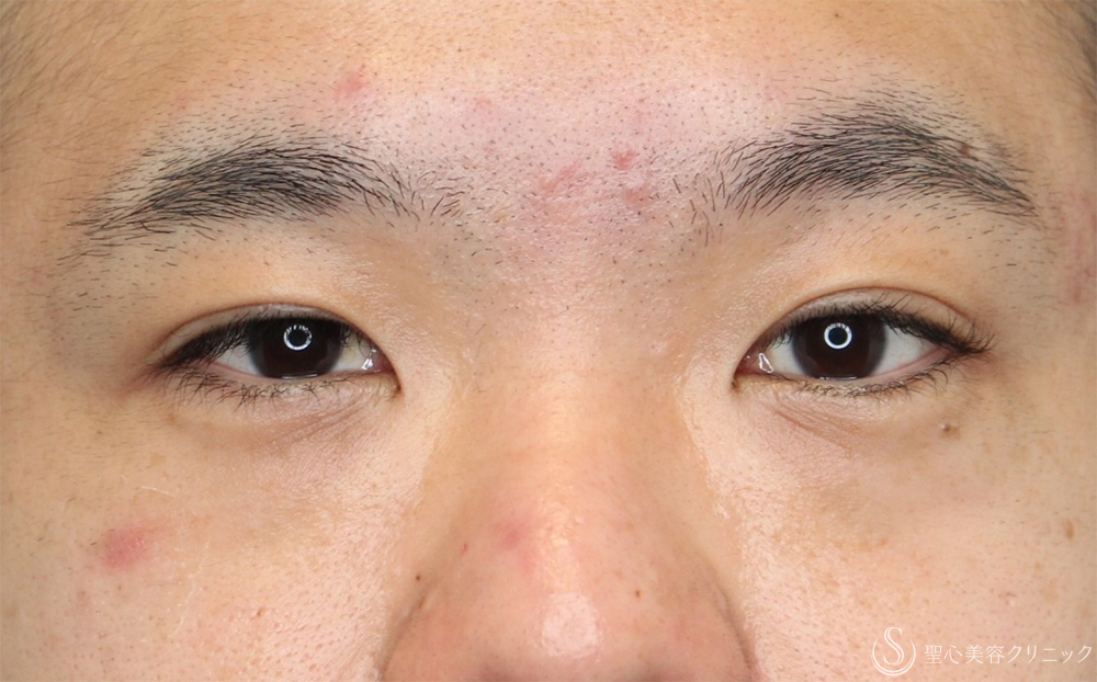 【30代男性・自然な二重に】二重埋没法：ダブルノット法（1ヶ月後） After 