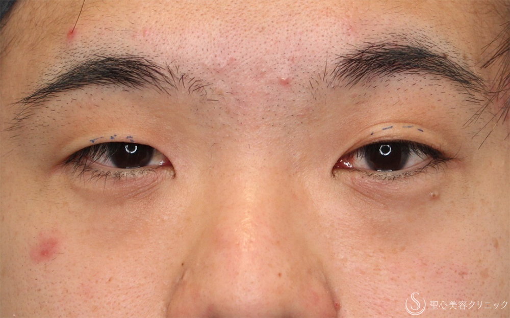 【30代男性・自然な二重に】二重埋没法：ダブルノット法（1ヶ月後） Before 