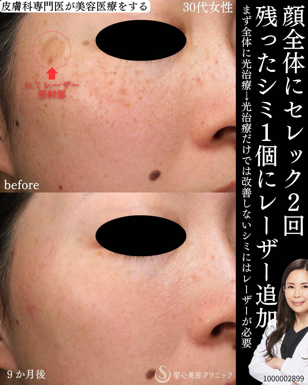 【30代女性・シミのない美肌に】セレックV2回＋シミレーザー（9ヶ月後） After 